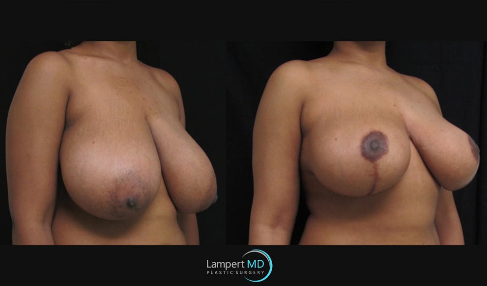 Breast Reduction Before & After Gallery - Patient 157558462 - Image 2