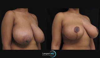Breast Reduction Before & After Gallery - Patient 157558462 - Image 2