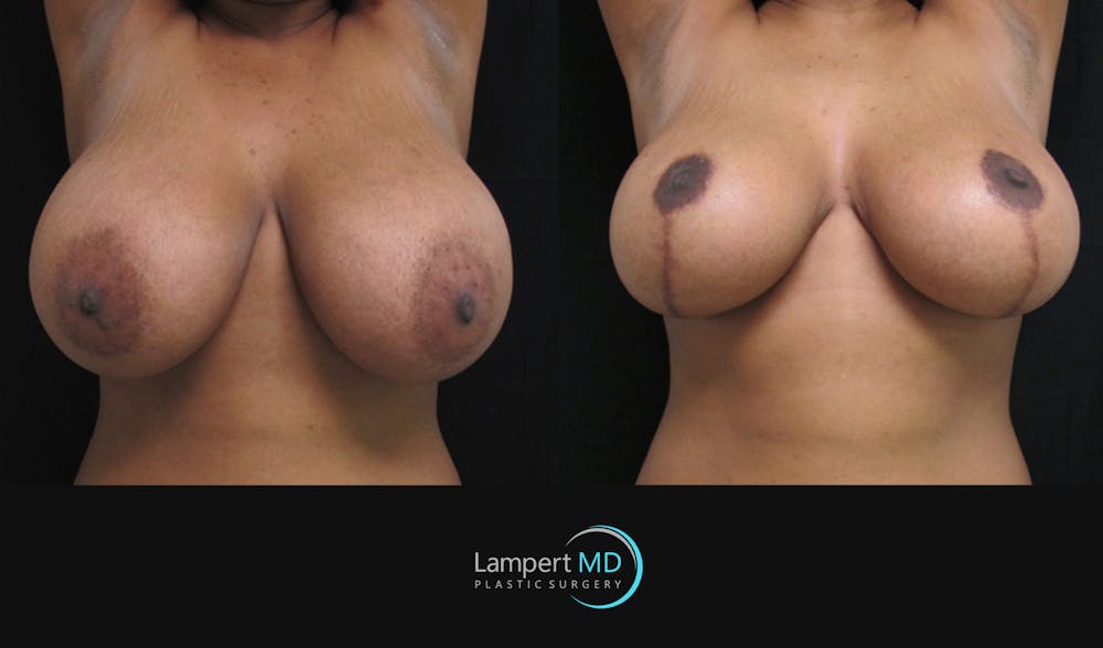 Breast Reduction Before & After Gallery - Patient 157558462 - Image 6