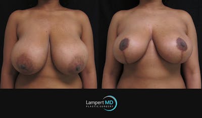 Breast Reduction Before & After Gallery - Patient 157558462 - Image 1