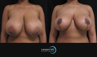 Breast Reduction Before & After Gallery - Patient 157558462 - Image 1