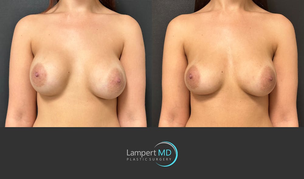 Breast Revision Before & After Gallery - Patient 157558617 - Image 1