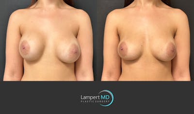 Breast Revision Before & After Gallery - Patient 157558617 - Image 1