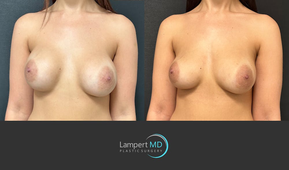 Breast Revision Before & After Gallery - Patient 157558617 - Image 2