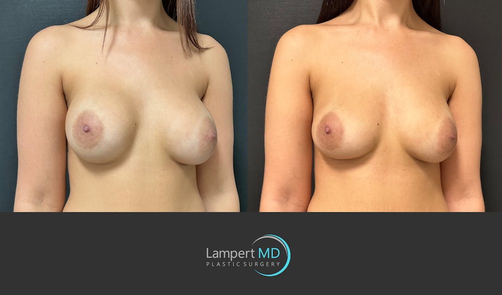 Breast Revision Before & After Gallery - Patient 157558617 - Image 3