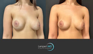 Breast Revision Before & After Gallery - Patient 157558617 - Image 3
