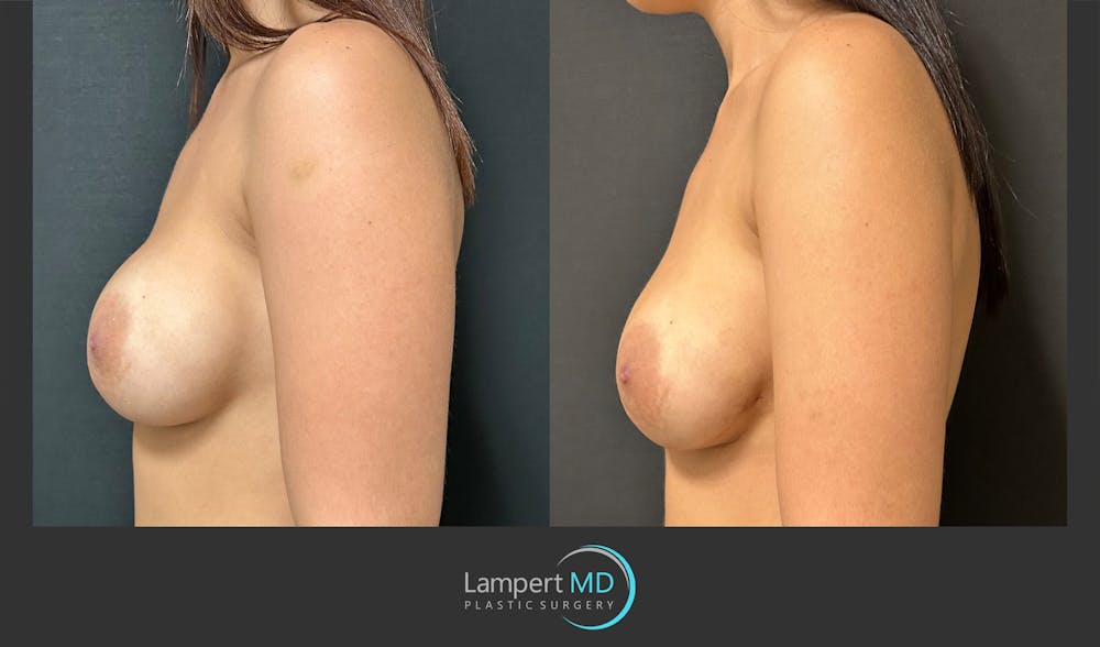 Breast Revision Before & After Gallery - Patient 157558617 - Image 4