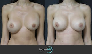 Breast Revision Before & After Gallery - Patient 157561489 - Image 1