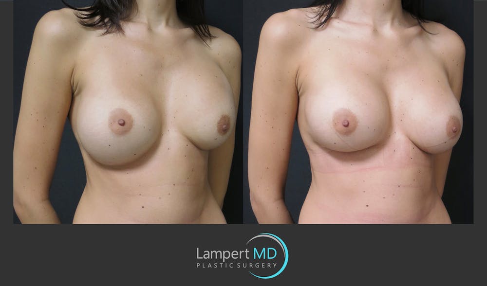 Breast Revision Before & After Gallery - Patient 157561489 - Image 2