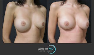 Breast Revision Before & After Gallery - Patient 157561489 - Image 2