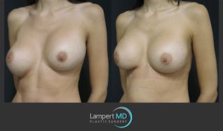 Breast Revision Before & After Gallery - Patient 157561489 - Image 3