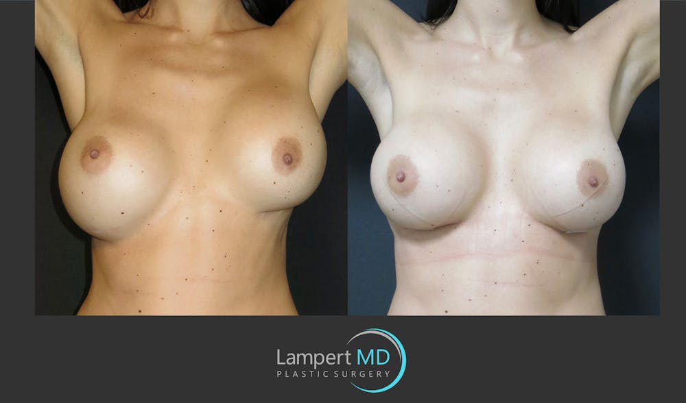Breast Revision Before & After Gallery - Patient 157561489 - Image 4