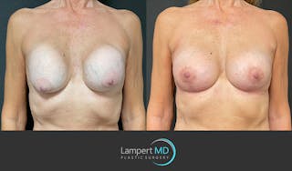 Breast Revision Before & After Gallery - Patient 157561491 - Image 1