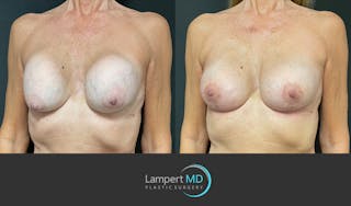 Breast Revision Before & After Gallery - Patient 157561491 - Image 2