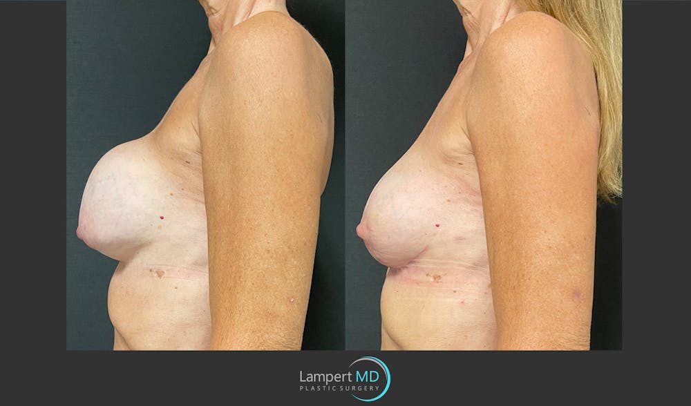 Breast Revision Before & After Gallery - Patient 157561491 - Image 3