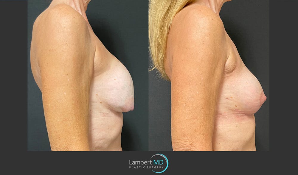 Breast Revision Before & After Gallery - Patient 157561491 - Image 4