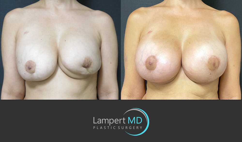 Breast Reconstruction Before & After Gallery - Patient 157561525 - Image 1