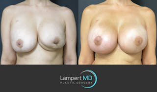 Breast Reconstruction Before & After Gallery - Patient 157561525 - Image 1