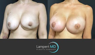 Breast Reconstruction Before & After Gallery - Patient 157561525 - Image 2