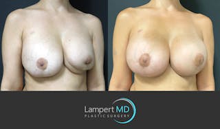 Breast Reconstruction Before & After Gallery - Patient 157561525 - Image 3