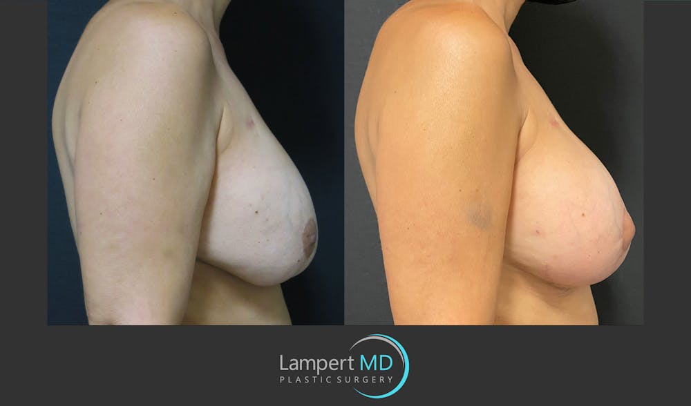 Breast Reconstruction Before & After Gallery - Patient 157561525 - Image 4