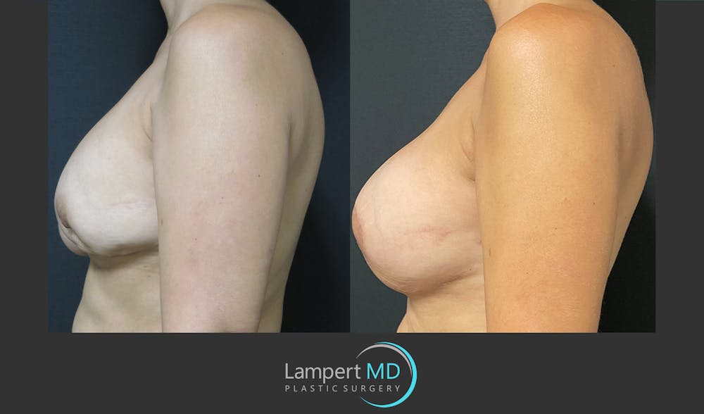 Breast Reconstruction Before & After Gallery - Patient 157561525 - Image 5