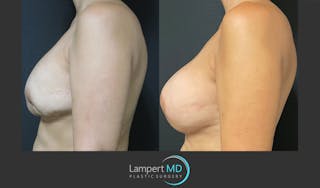 Breast Reconstruction Before & After Gallery - Patient 157561525 - Image 5