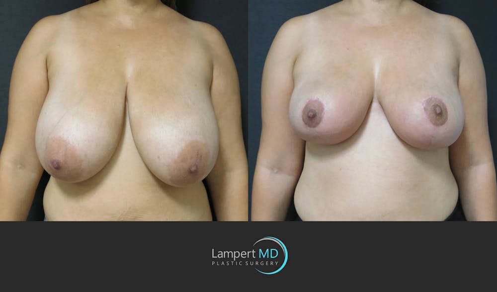 Breast Reduction Before & After Gallery - Patient 159006548 - Image 1