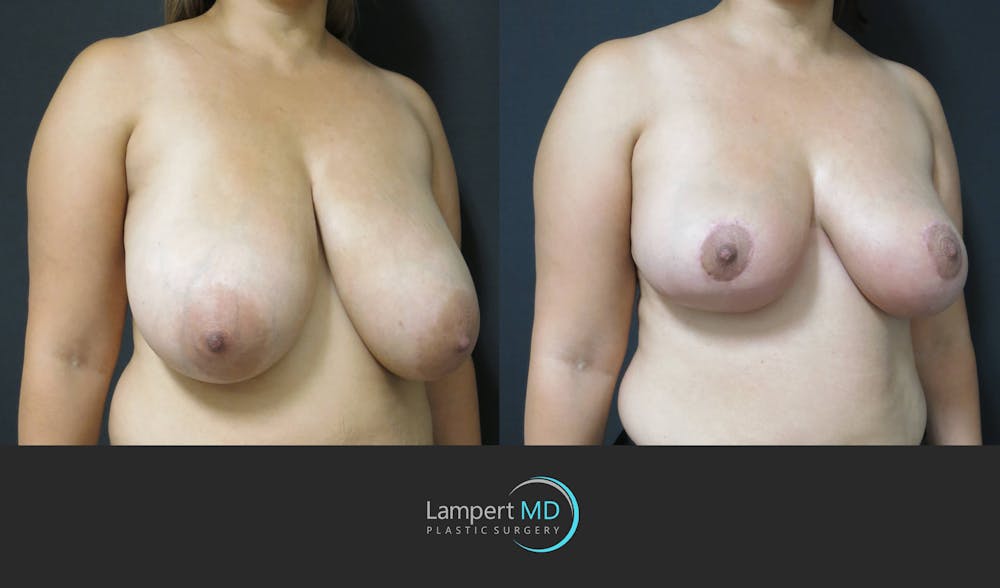 Breast Reduction Before & After Gallery - Patient 159006548 - Image 2
