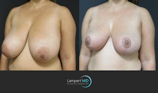 Breast Reduction Before & After Gallery - Patient 159006548 - Image 3