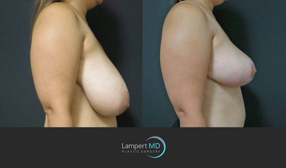 Breast Reduction Before & After Gallery - Patient 159006548 - Image 4