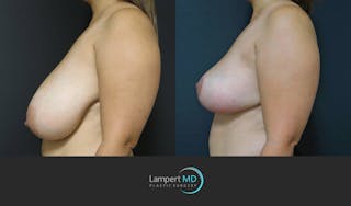 Breast Reduction Before & After Gallery - Patient 159006548 - Image 5