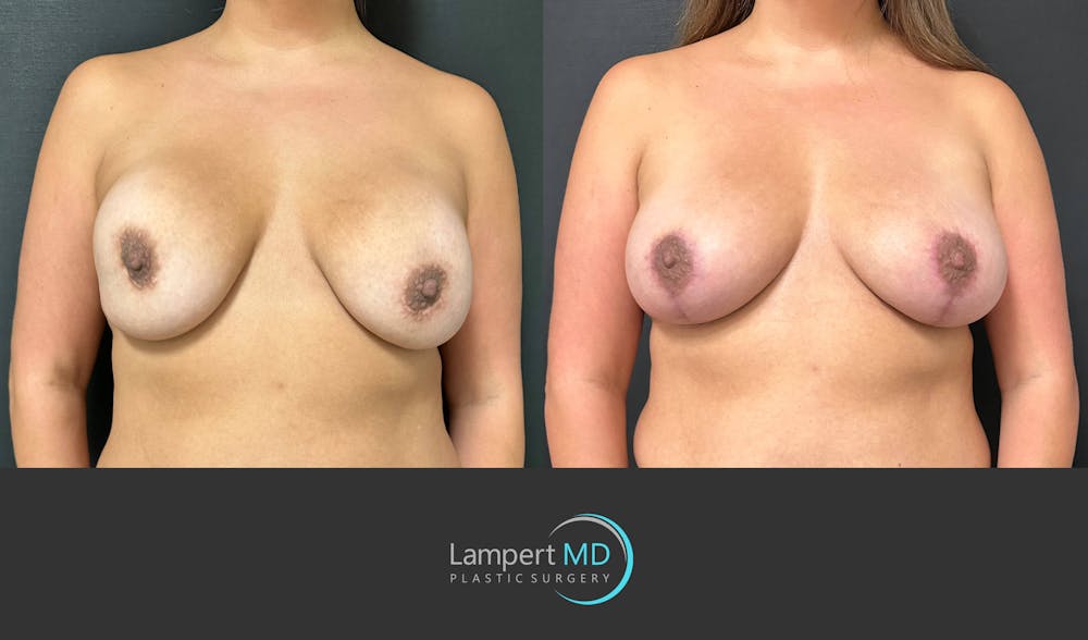 Breast Revision Before & After Gallery - Patient 159006567 - Image 1