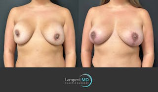 Breast Revision Before & After Gallery - Patient 159006567 - Image 2