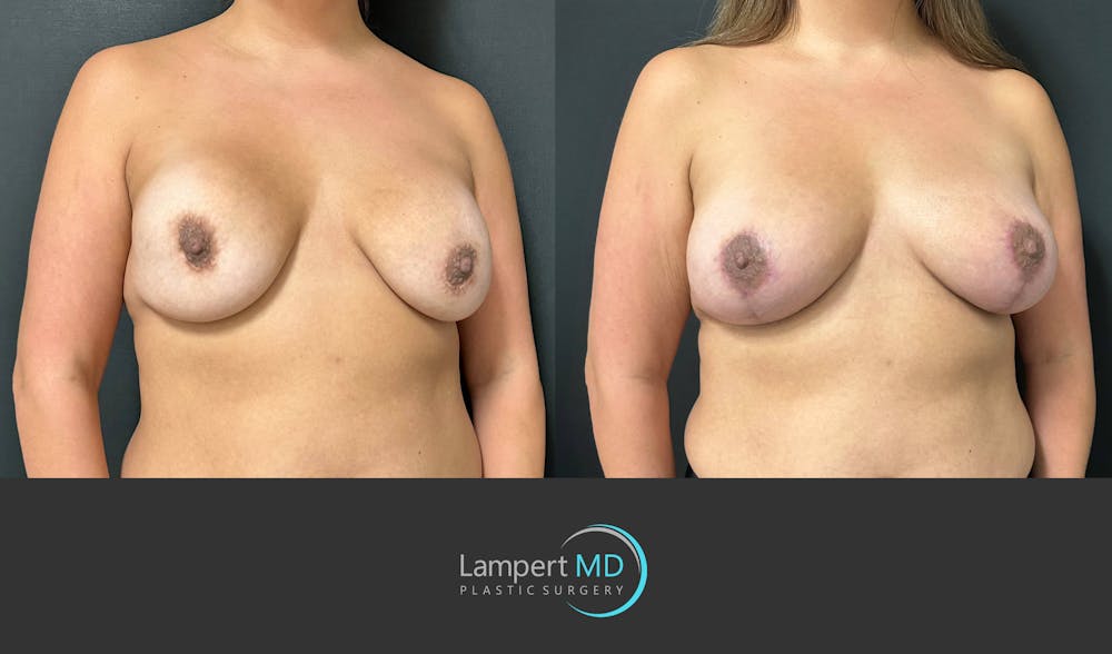 Breast Revision Before & After Gallery - Patient 159006567 - Image 3