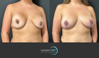 Breast Revision Before & After Gallery - Patient 159006567 - Image 3