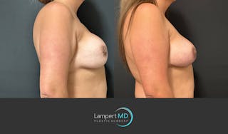 Breast Revision Before & After Gallery - Patient 159006567 - Image 4