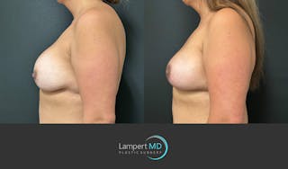 Breast Revision Before & After Gallery - Patient 159006567 - Image 5