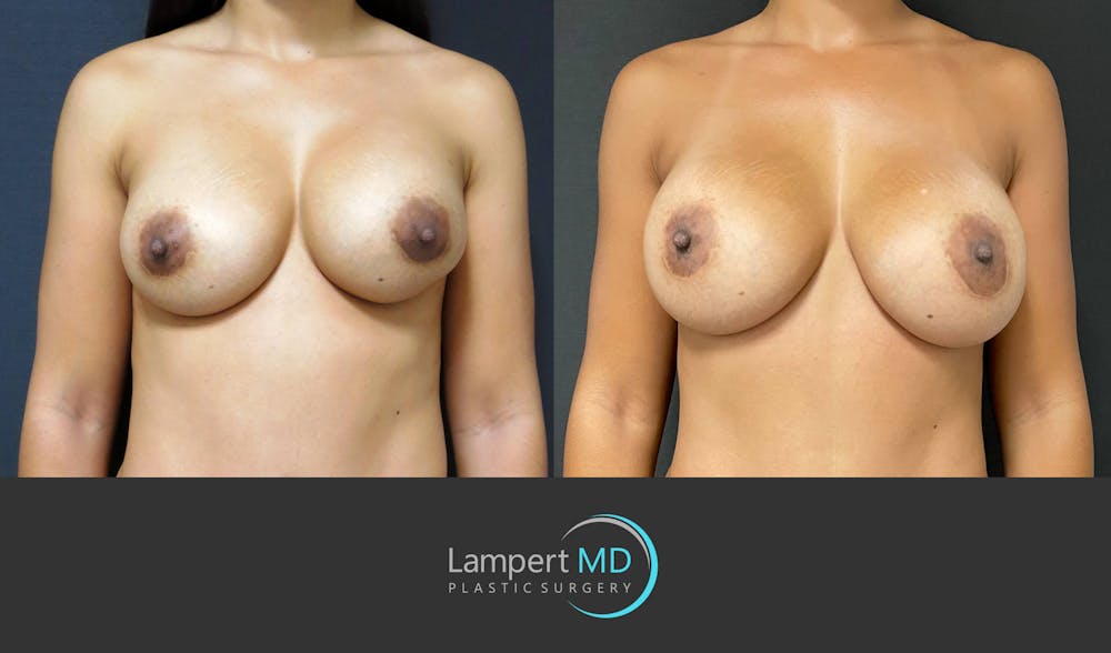 Breast Revision Before & After Gallery - Patient 159006566 - Image 1