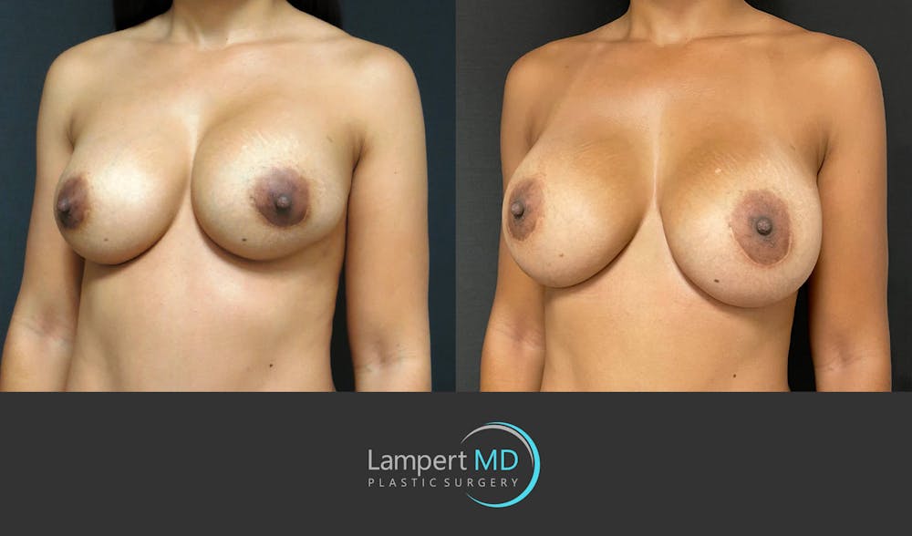 Breast Revision Before & After Gallery - Patient 159006566 - Image 2