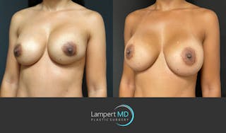Breast Revision Before & After Gallery - Patient 159006566 - Image 2