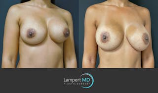 Breast Revision Before & After Gallery - Patient 159006566 - Image 3