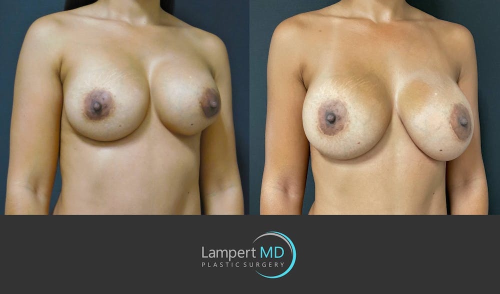 Breast Revision Before & After Gallery - Patient 159006566 - Image 3