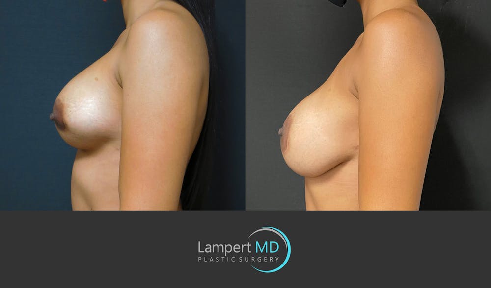 Breast Revision Before & After Gallery - Patient 159006566 - Image 4