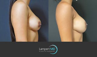 Breast Revision Before & After Gallery - Patient 159006566 - Image 5