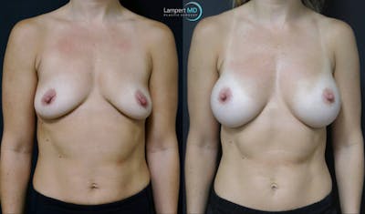Breast Augmentation Before & After Gallery - Patient 122908740 - Image 1