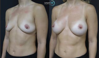 Breast Augmentation Before & After Gallery - Patient 122908740 - Image 2