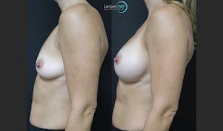Breast Augmentation Before & After Gallery - Patient 122908740 - Image 3