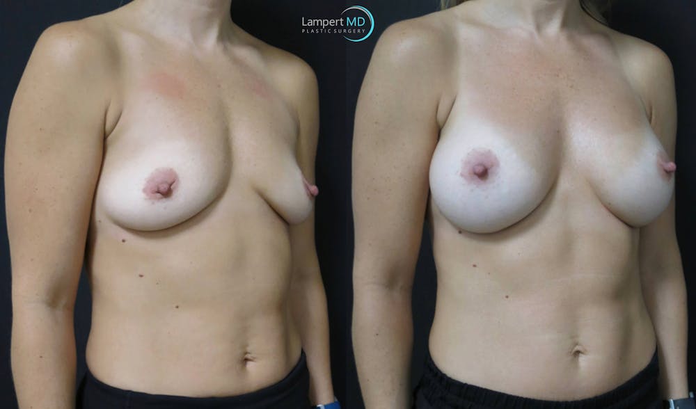 Breast Augmentation Before & After Gallery - Patient 122908740 - Image 5