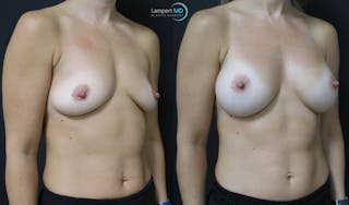 Breast Augmentation Before & After Gallery - Patient 122908740 - Image 5